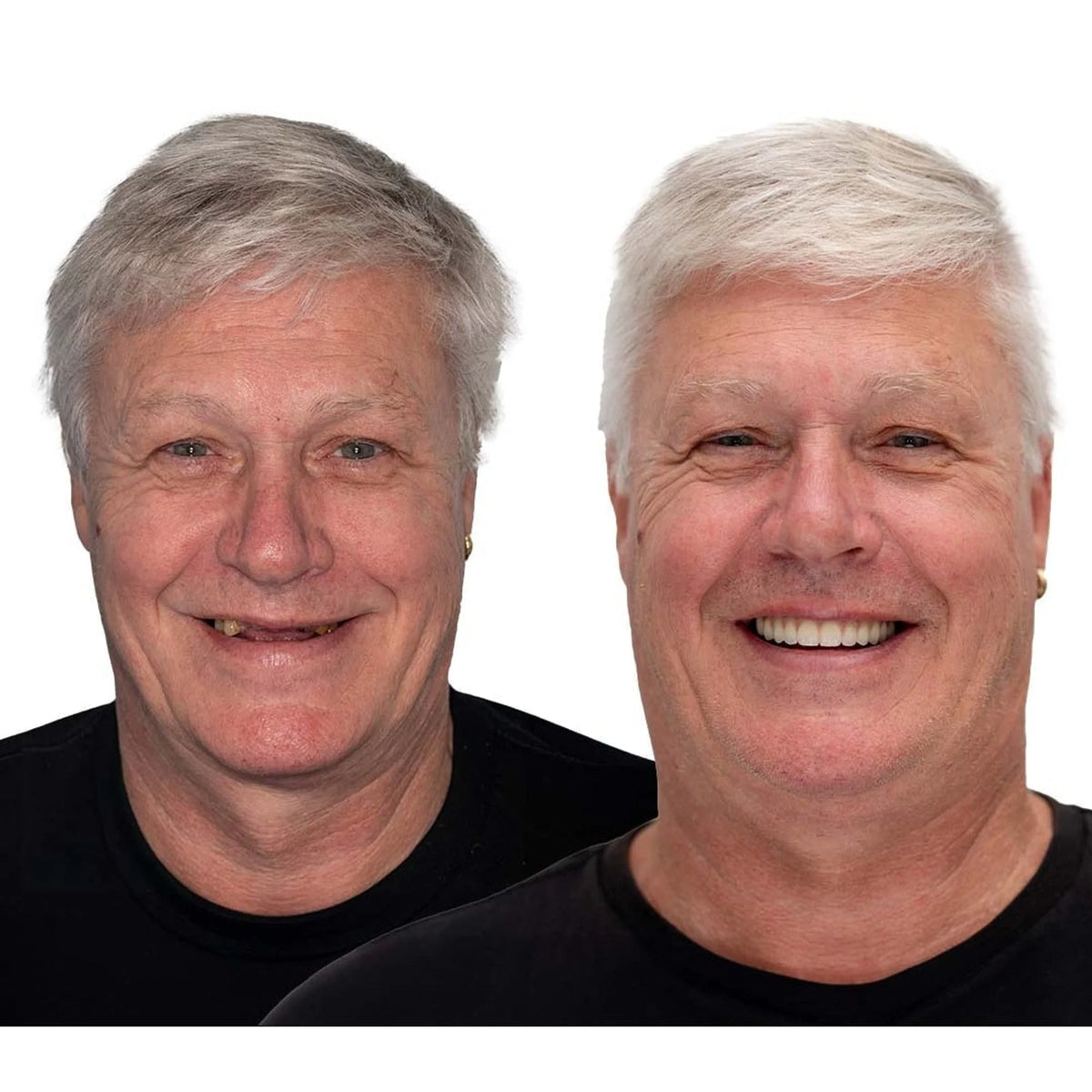 Removable Denture Set Upper & Lower Arches Flexible Cushion Grip