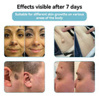 Skin Laser Pen Micro-Focused CO2 Compact Handheld