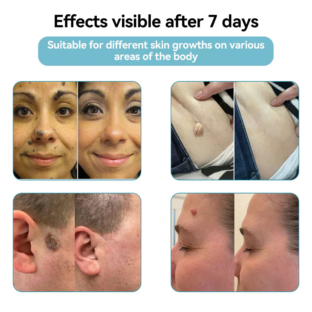 Skin Laser Pen Micro-Focused CO2 Compact Handheld