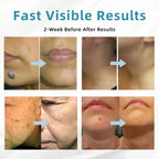 Skin Laser Pen Micro-Focused CO2 Compact Handheld