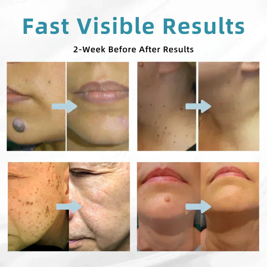 Skin Laser Pen Micro-Focused CO2 Compact Handheld