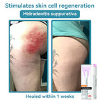 Skin Laser Pen Micro-Focused CO2 Compact Handheld