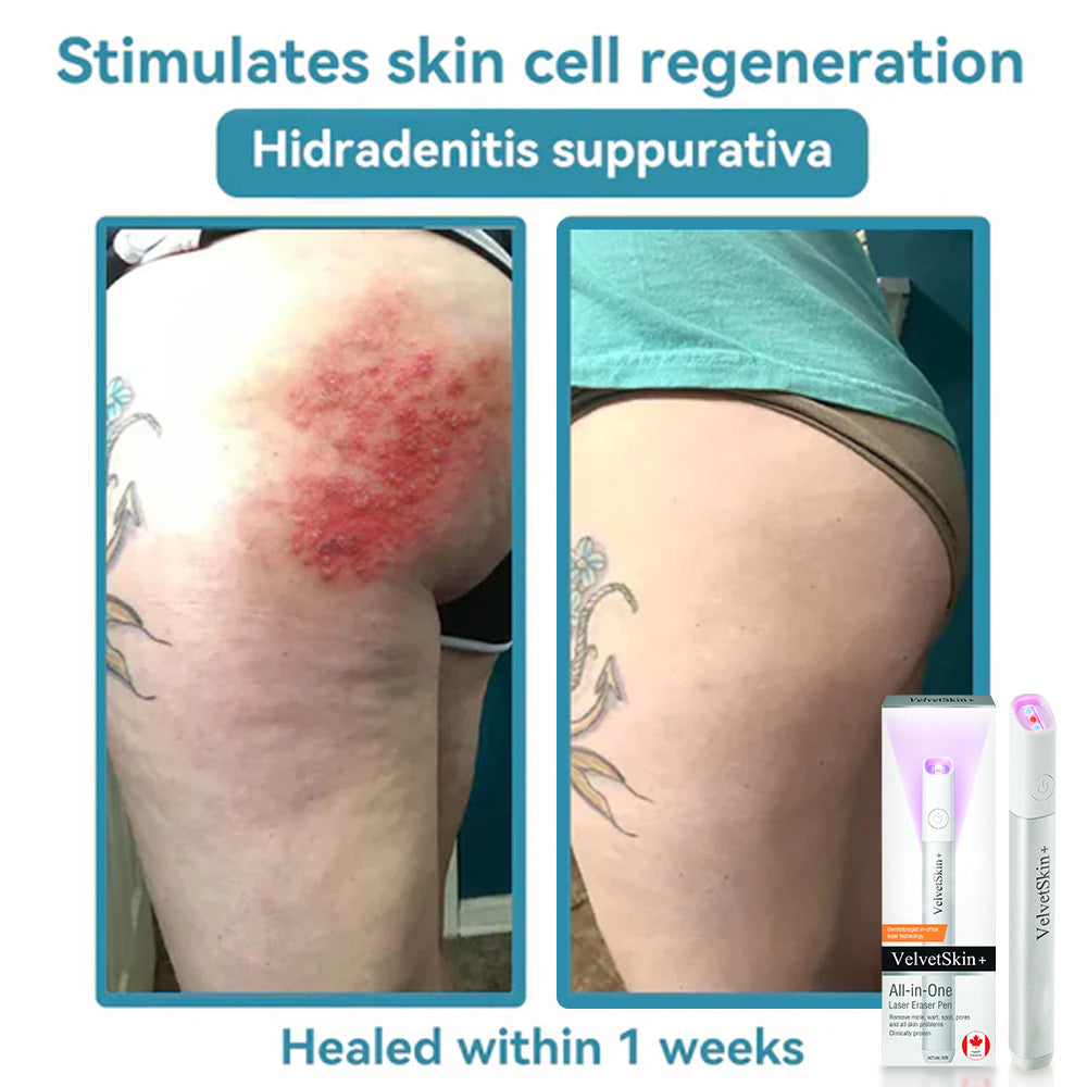 Skin Laser Pen Micro-Focused CO2 Compact Handheld