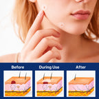 Skin Tag Patches Gentle & Discreet Wear