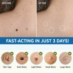 Skin Tag Patches Gentle & Discreet Wear