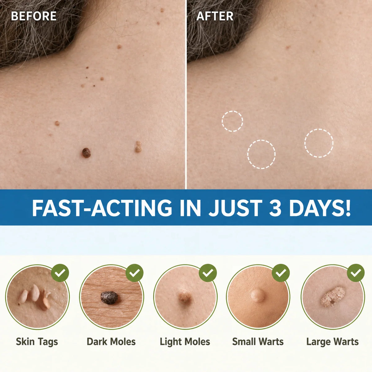 Skin Tag Patches Gentle & Discreet Wear